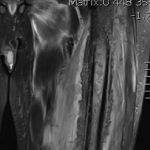 Fig. 2 Coronal T2-weighted MRI of the left thigh demonstrating altered marrow signal and enhancement, periosteal reaction, and cortical erosion of the left femur as well as edema of the surrounding musculature and soft tissue.
