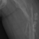Fig. 3 Posteroanterior radiograph of the left hip demonstrating a pathologic femoral fracture and antibiotic beads placed during prior debridement.
