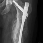 Fig. 4-A Posteroanterior radiograph of the left hip and thigh six months after placement of an antibiotic-coated cephalomedullary nail. Healing of the fracture with abundant callus is seen. The radiograph shows the proximal part of the femur.
