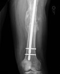 Fig. 4-B Posteroanterior radiograph of the left hip and thigh six months after placement of an antibiotic-coated cephalomedullary nail. Healing of the fracture with abundant callus is seen. The radiograph shows the distal part of the femur.
