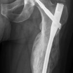 Fig. 5-A Posteroanterior radiograph of the left hip and thigh one year after placement of an antibiotic-coated cephalomedullary nail. Continued healing of the fracture with maturing callus is seen. The radiograph shows the proximal part of the femur.
