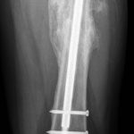 Fig. 5-B Posteroanterior radiograph of the left hip and thigh one year after placement of an antibiotic-coated cephalomedullary nail. Continued healing of the fracture with maturing callus is seen. The radiograph shows the distal part of the femur.
