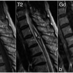 Fig. 1 MRI. Preoperative T1 and T2-weighted MRI reveals a heterogeneous picture (Fig. 1-A). Preoperative gadolinium (Gd)-enhanced T1-weighted MRI shows no contrast enhancement (Fig. 1-B).
