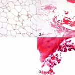 Fig. 3 Histological examination. S100 protein immunostain (×400) (Fig. 3-A). Hematoxylin and eosin (HE) stain (×20) (Fig. 3-B). HE stain (×200) (Fig. 3-C).
