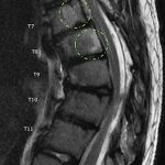 Fig. 2-A On T2-weighted MRI, hyperintense signals are seen in the vertebral bodies. These signals were contrast-enhancing and fat-suppressible (circles).
