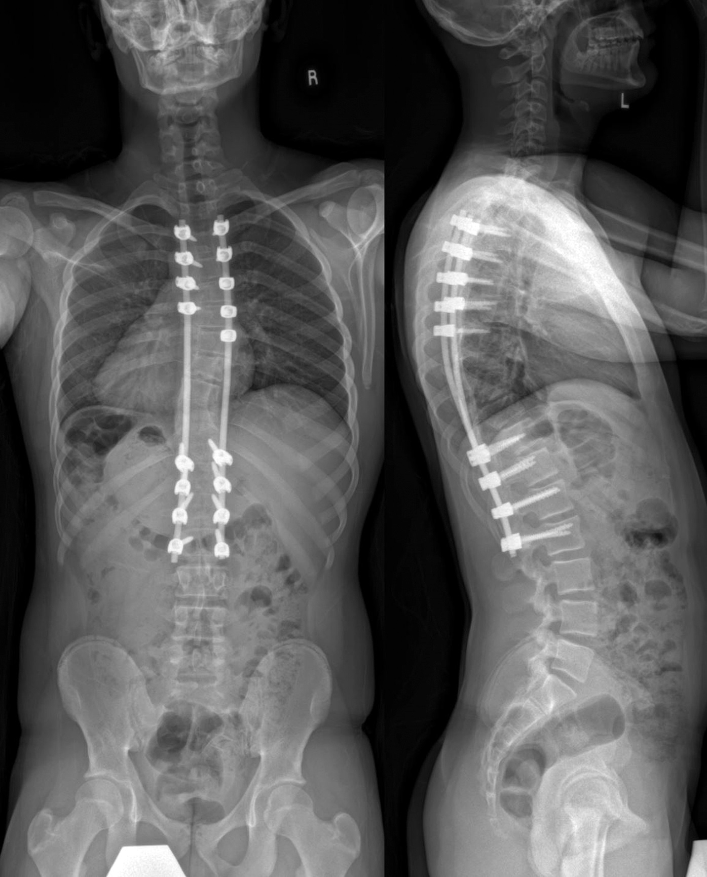 a-14-year-old-boy-with-severe-scoliosis-deformity-jbjs-image-quiz