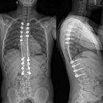 Fig. 5 Posteroanterior (left) and lateral (right) standing radiographs demonstrating the intact hardware, the continued alignment of the correction, and no interval change in the osteolysis of the left ribs at T9 and T10 at 18 months after the index procedure.
