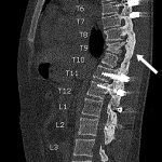 A 14-Year-Old Boy with Severe Scoliosis Deformity