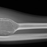 Fig. 1 Lateral radiograph of the right forearm showing the expansile lesion of the proximal aspect of the radius.
