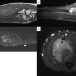 Fig. 2 T1-weighted (Fig. 2-A), T2-weighted (Fig. 2-B), and T1-weighted, fat-suppressed, post contrast MRI of the right forearm (Fig. 2-C; top: coronal; bottom: axial plane).
