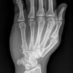 Fig. 1-B Oblique radiograph of the hand that was made on the day of injury.
