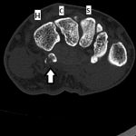 Fig. 2-B Axial CT image reveals the presence of a comminuted fracture (arrow). H = hamate, C = capitate, and S = scaphoid.
