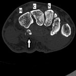 Fig. 2-D Axial CT image reveals the presence of a comminuted fracture (arrow). H = hamate, C = capitate, and S = scaphoid.
