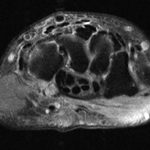 Fig. 3-A T2-weighted axial MRI reveals the presence of a comminuted fracture with edema over the distal aspect of the hamate with subchondral bone-marrow edema, consistent with an acute contusion.
