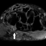 Fig. 3-B T2-weighted, fat-suppressed MRI reveals the presence of a comminuted fracture with edema over the distal aspect of the hamate with subchondral bone-marrow edema (arrow), consistent with an acute contusion.
