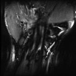 Fig. 3-C T2-weighted coronal MRI reveals the presence of a comminuted fracture with edema over the distal aspect of the hamate with subchondral bone-marrow edema, consistent with an acute contusion.
