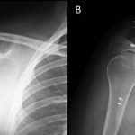 A 31-Year-Old Woman with Growing Shoulder Pain