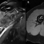 Fig. 4 Two years postresection, MRI of the right shoulder demonstrating T1-weighted fat-suppressed contrast sequences in the sagittal (Fig. 4-A) and axial (Fig. 4-B) planes.
