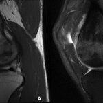 Fig. 3 Sagittal T1-weighted (Fig. 3-A) and sagittal T2-weighted (Fig. 3-B) MRI scans reveal low T1, high T2 lesion in the medial femoral condyle.
