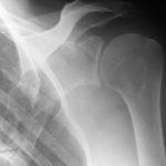 Fig. 1-A A radiograph of the left shoulder taken 9 years before the patient presented to our hospital, showing the fracture line running through the glenoid fossa.
