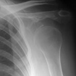 Fig. 1-B A radiograph of the left shoulder taken 6 years before the patient presented to our hospital, showing osteolysis of the scapula.
