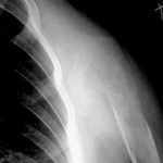 Fig. 1-C A radiograph of the left shoulder taken at the patient’s initial visit to our hospital, indicating osteolysis accompanied by the disappearance of the scapula, clavicle, and humeral head.
