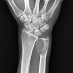 Fig. 1 Posteroanterior radiograph demonstrating an expansile lesion in the right ulnar head with bone destruction.
