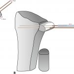 Fig. 6 Harvesting a size-matched bone graft. Fig. 6-A The guide pins should be set before the osteotomies are performed. Fig. 6-B The bone graft was fixed onto the sigmoid notch and then fixed with 2 cannulated screws via the 2 pins.
