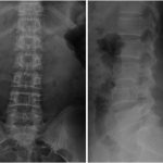 Fig. 1 Preoperative anteroposterior (left) and lateral (right) radiographs of the lumbar spine showing a well-defined radiolucency of the L4 vertebral body with mild collapse of the vertebral plate.
