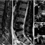 Fig. 3 MRI scans. Fig. 3-A Sagittal T1-weighted image showing hypointensity of the L4 vertebra. Fig. 3-B Sagittal T2-weighted image revealing heterogeneous signal intensity of the L4 lesion and the high-intensity zone of the disc at the L4-L5 level. Fig. 3-C A surrounding hypointense halo is evident (also seen in Fig. 3-A). Fig. 3-D Axial T2-weighted image at the L4-L5 level showing disc herniation on the left side.
