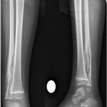 A 4-Year-Old Boy with Worsening Ankle Pain