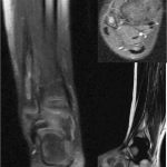 Fig. 6 Recession in pathologic signs on MRI after 6 months.
