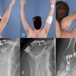 Fig. 3 Clinical photographs demonstrating postoperative forward flexion (Fig. 3-A), lateral flexion (Fig. 3-B), and abduction/external rotation (Fig. 3-C) that had been achieved 17 months after surgery. Anteroposterior (Fig. 3-D), lateral (Fig. 3-E), and axillary (Fig. 3-F) radiographs illustrating fixed pelvic bone graft using two 3.5-mm T-shaped angular stable plates (DePuy Synthes).
