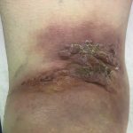 An 87-Year-Old Woman with a Worsening Skin Lesion