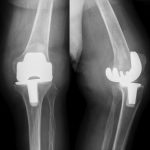 Fig. 2 Anteroposterior and lateral radiographs of the knee demonstrate an anterior subluxation of the tibia and polyethylene wear.
