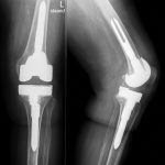 Fig. 7 Postoperative anteroposterior and lateral radiographs of the knee with posterior stabilized cemented stemmed femoral and tibial components and a polyethylene insert.
