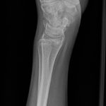 A 16-Year-Old Boy with Long-Term Wrist Pain