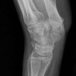 Fig. 5 Radiograph (lateral view) of the left wrist after 1 year of follow-up showing no recurrence of the DEH lesion and complete excision.

