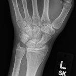 Fig. 6 Radiograph (anteroposterior view) of the left wrist after 1 year of follow-up showing no recurrence of the DEH lesion and complete excision.
