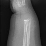 Fig. 1-A Lateral radiograph of the wrist made at initial presentation demonstrates a subacute metaphyseal corner fracture of the distal part of the radius with associated periosteal reaction along the radius.
