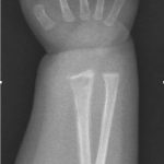 Fig. 1-B Anteroposterior radiograph of the wrist made at initial presentation demonstrates a subacute metaphyseal corner fracture of the distal part of the radius with associated periosteal reaction along the radius.
