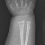 Fig. 2-A Anteroposterior radiograph of the right wrist made at 1 week after initial presentation obtained as part of the skeletal survey demonstrates an irregular lucency of the radius most pronounced distally with associated periosteal reaction along the entirety of the bone. There is also a periosteal reaction seen about the distal part of the ulna.
