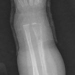 Fig. 2-B Lateral radiograph of the right wrist made at 1 week after initial presentation obtained as part of the skeletal survey demonstrates an irregular lucency of the radius most pronounced distally with associated periosteal reaction along the entirety of the bone. There is also a periosteal reaction seen about the distal part of the ulna.
