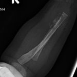 Fig. 4-A Lateral radiograph of the right forearm made approximately 2 weeks after the last hospital admission demonstrates progressive osteolysis and destruction of the radius with associated periosteal reaction about the radius and ulna. There is also a lucency noted in the proximal part of the ulna.

