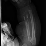 Fig. 4-B Anteroposterior radiograph of the right forearm made approximately 2 weeks after the last hospital admission demonstrates progressive osteolysis and destruction of the radius with associated periosteal reaction about the radius and ulna. There is also a lucency noted in the proximal part of the ulna.
