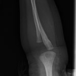 Fig. 5-A Lateral radiograph of the left forearm demonstrates a subtle lucency within the radius and ulna with associated periosteal reaction along the entirety of the forearm.
