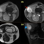 Fig. 2 MRI of the distal thigh. Fig. 2-A T1-weighted (fat-suppressed without contrast), axial MRI at the level of the distal left thigh, and gadolinium-enhanced (Fig. 2-B). The arrow points to a mass that is well circumscribed, but with hypointense signaling of the mineralized peripheral rim and septations. Fluid-fluid levels are minimally enhanced after gadolinium administration. Fig. 2-C A T2-weighted, axial MRI demonstrates a well-encapsulated heterogeneous lesion (dashed arrow) with septations in the vastus medialis and multiple fluid-fluid levels (representing hemorrhagic spaces). Fig. 2-D A proton density, fat-suppressed, coronal MRI of the mass demonstrates the well-encapsulated heterogeneous mass (shown by the arrowhead), with hypointense signaling of the outer capsule and the inner septations.

