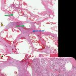 Fig. 3 Histologic sections taken by a core needle biopsy from the vastus medialis. Fibrous septations (indicated by blue dashed arrows) showing signs of ossification, aggregates of spindle cells, inflammatory cells, and occasional osteoclast-like multinucleated giant cells. Solid green arrows point at pseudocystic spaces. Bone spicules can also be noted (black arrowhead). No cytological atypia was noted, and mitotic figures were low. Hematoxylin and eosin, 12.5× (Fig. 3-A), 40× (Fig. 3-B), 100× (Fig. 3-C).

