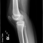 Fig. 1 Radiograph of the injured knee (lateral view) showed cortical irregularity involving the superior patellar pole.
