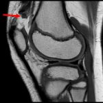 Fig. 2 Sagittal T1-weighted MRI of the injured knee. The arrow indicates a 1.5 × 0.5 cm mass.
